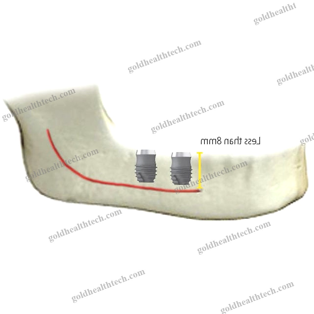 Titanium Dental Implant