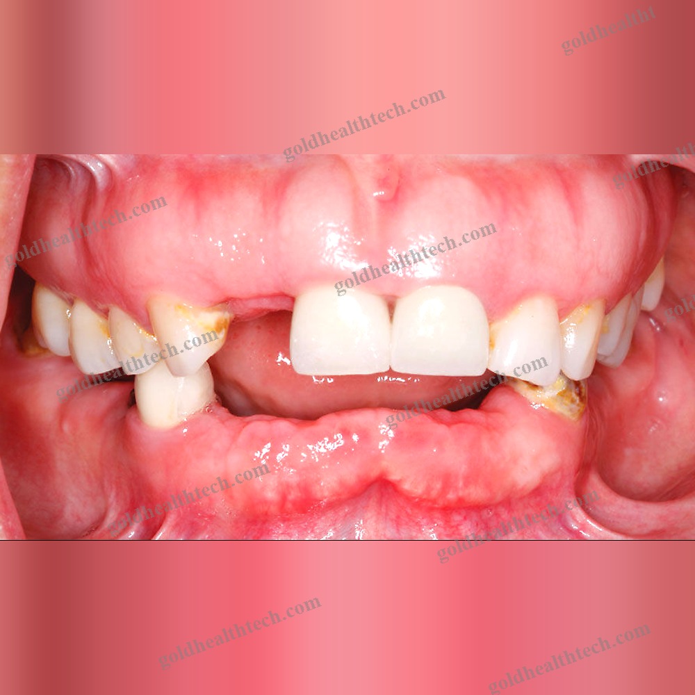 Zirconia Dental Prosthesis