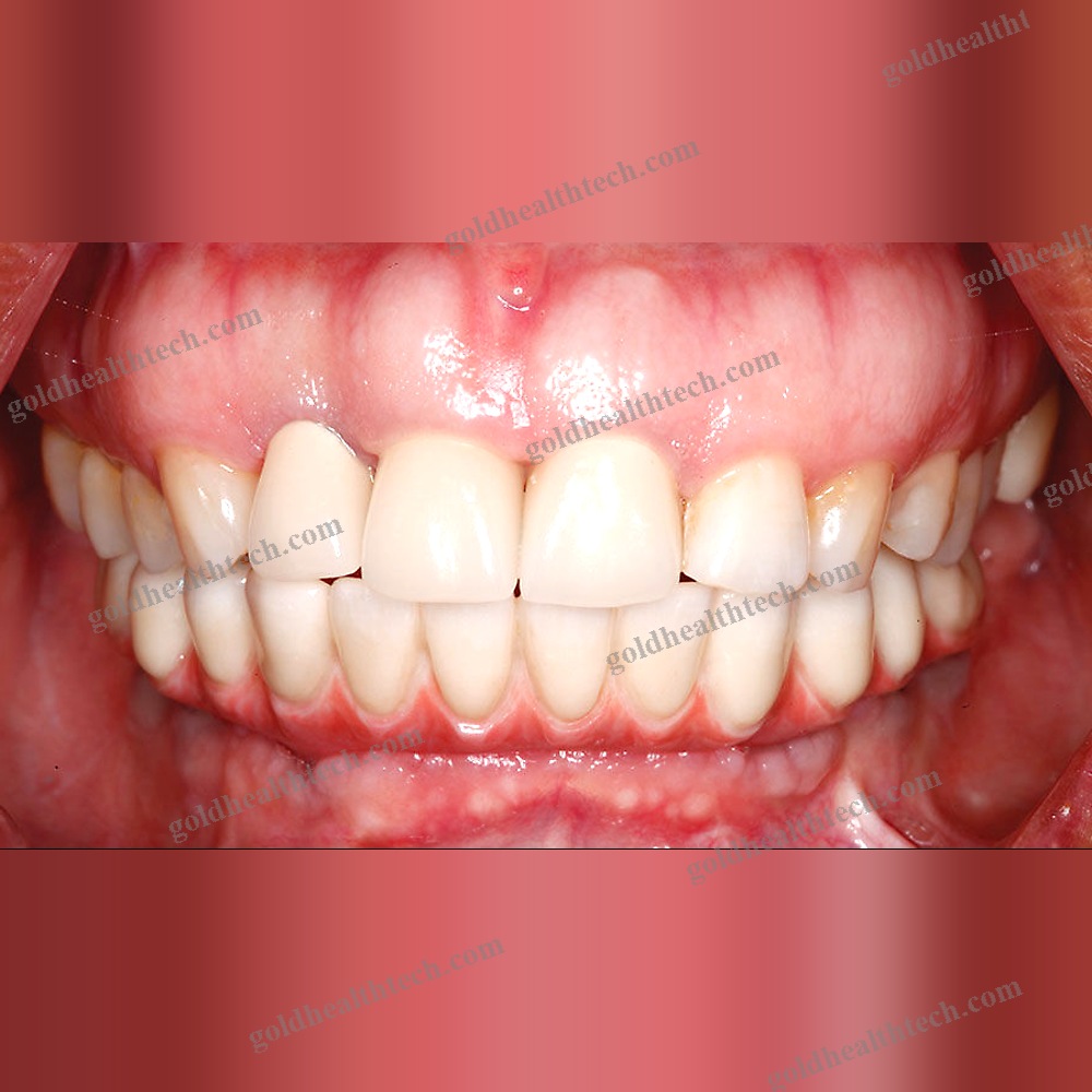 Zirconia Dental Prosthesis