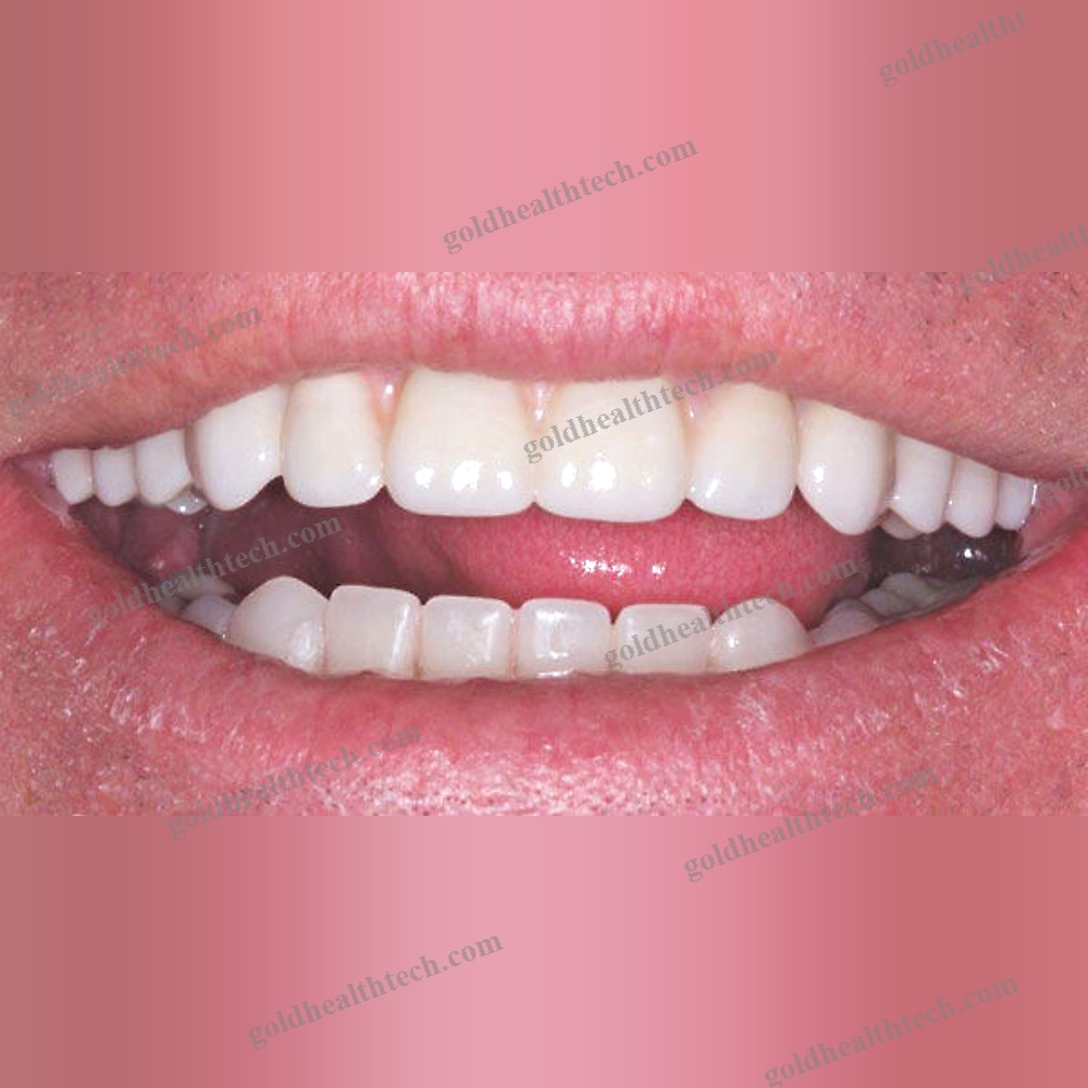 Zirconia Dental Prosthesis