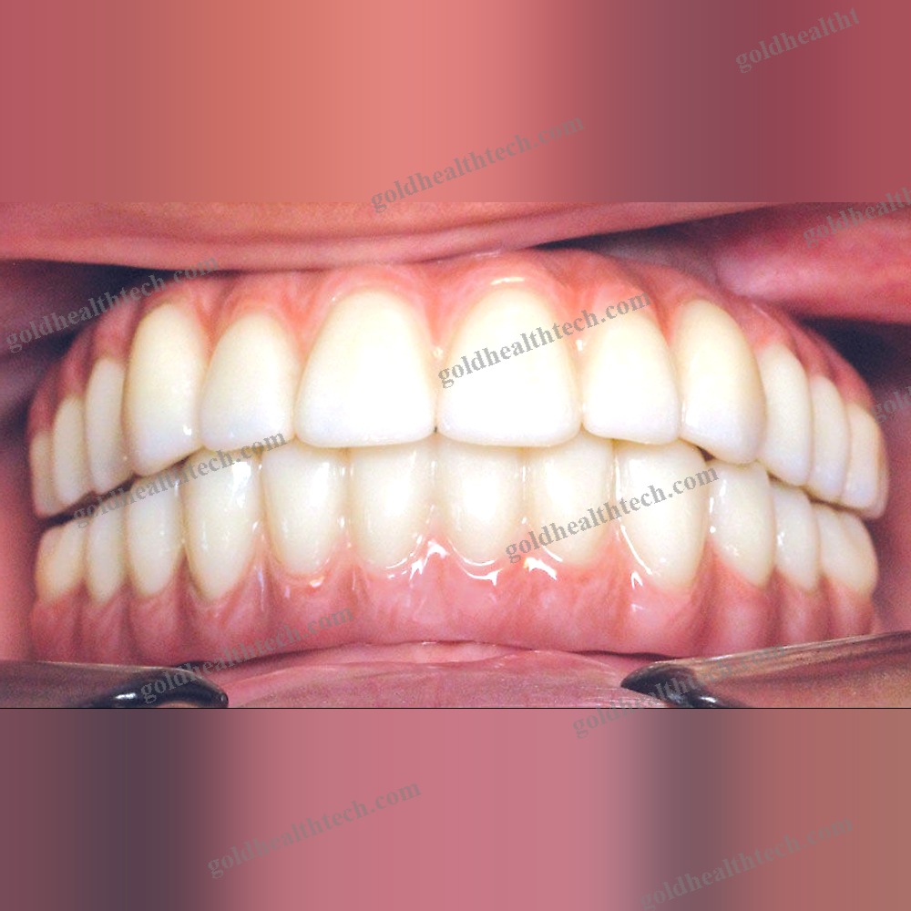 Zirconia Dental Prosthesis