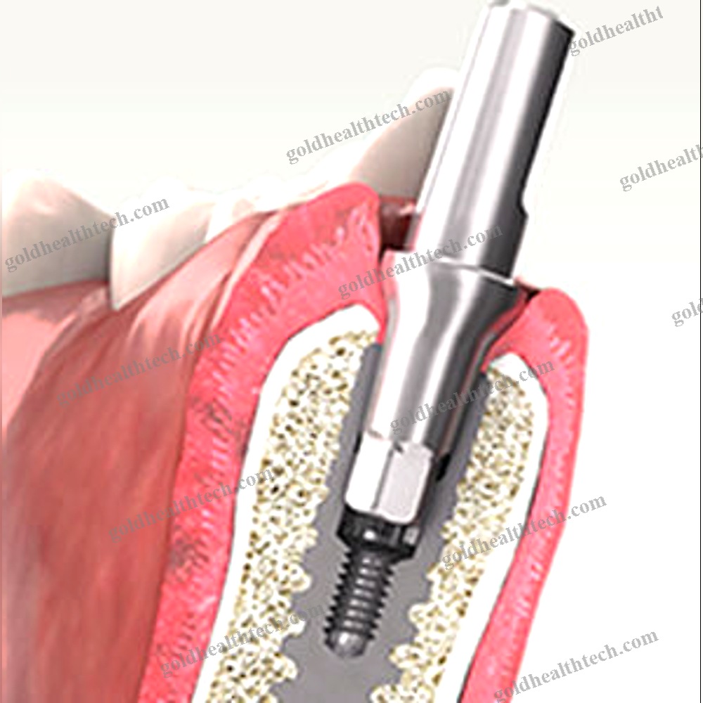 Conical Dental Implant