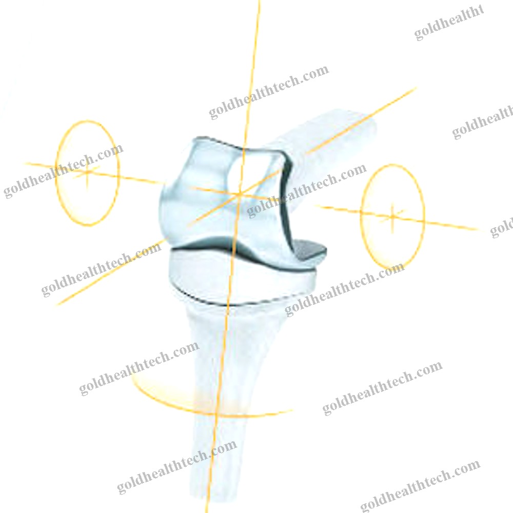 Interphalangeal Hand Joint Implant