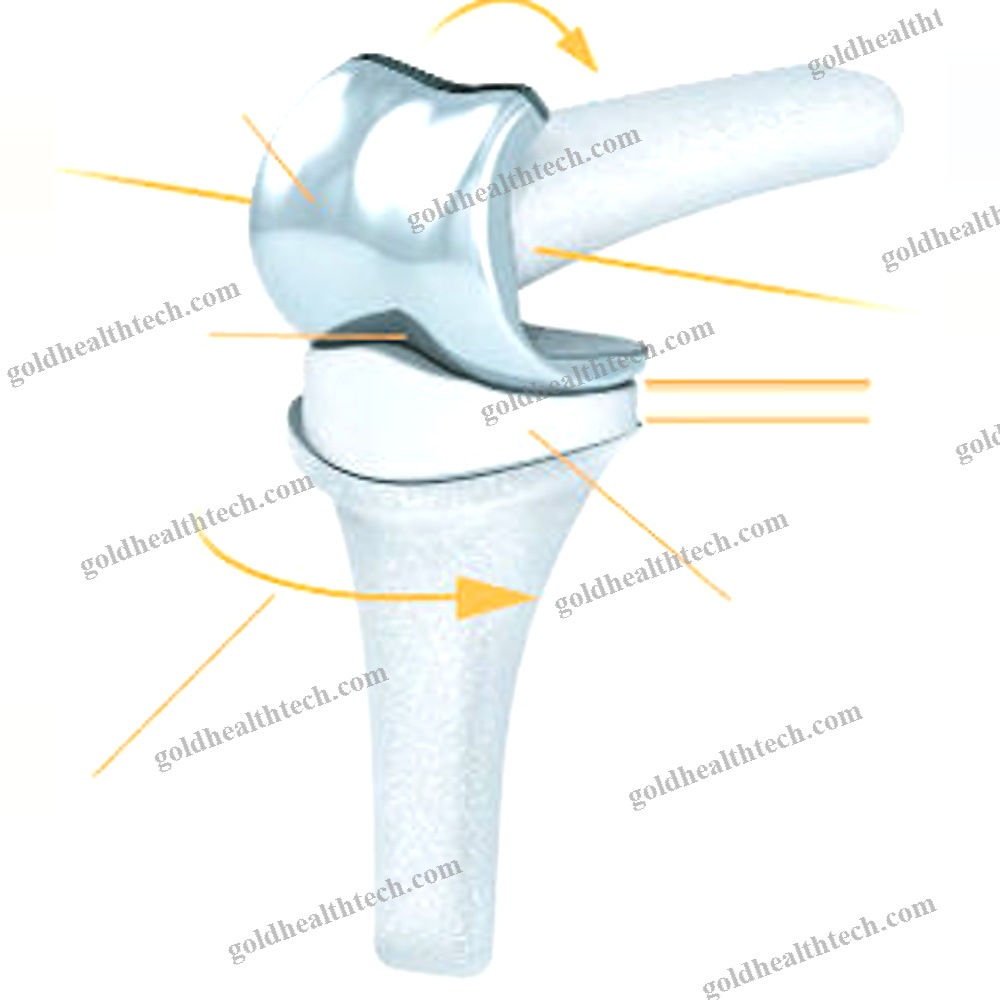 Interphalangeal Hand Joint Implant