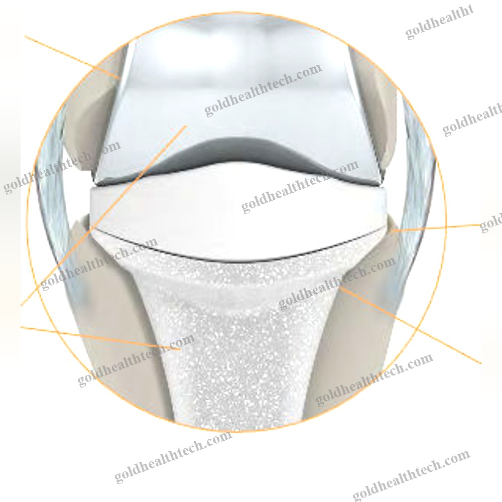 Interphalangeal Hand Joint Implant