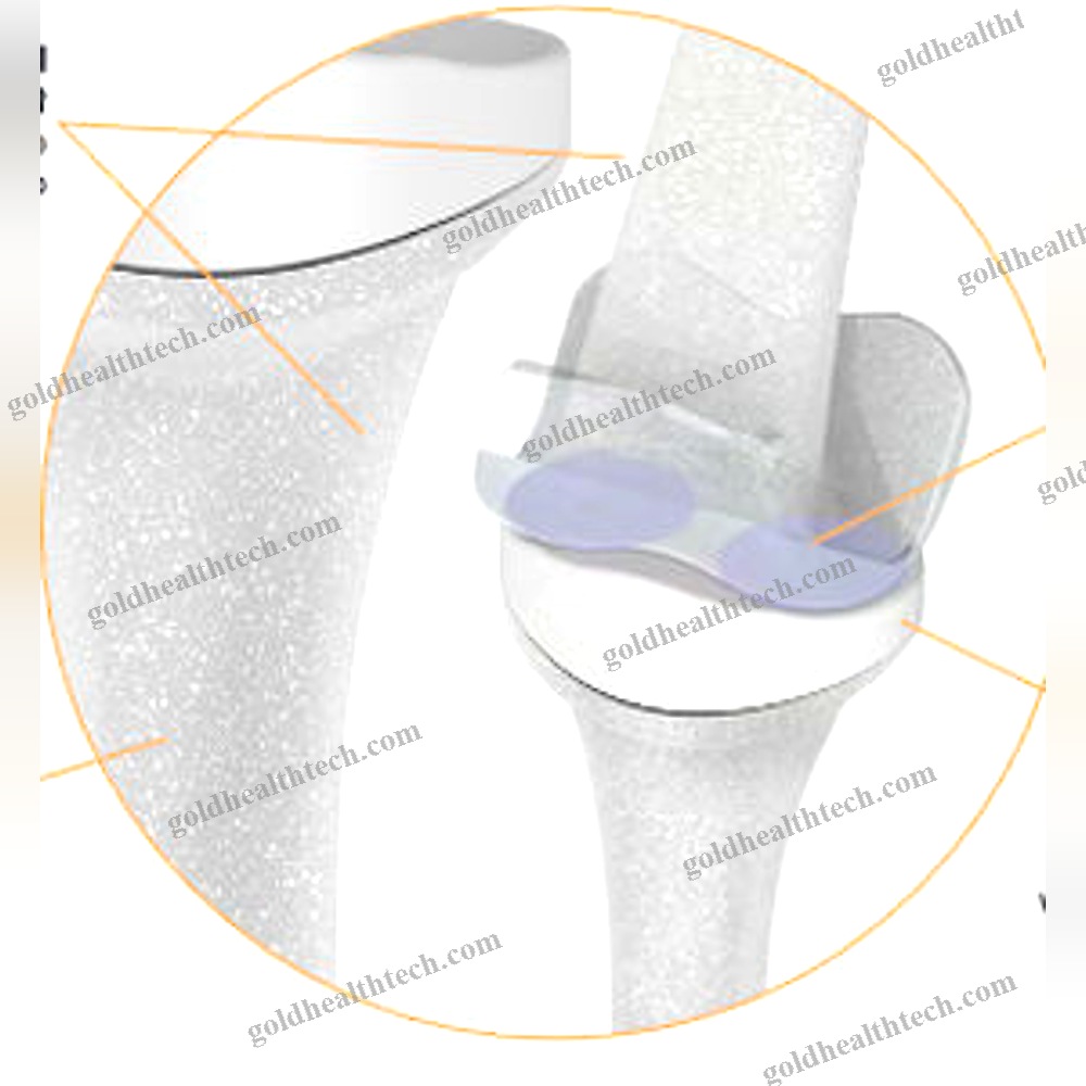 Interphalangeal Hand Joint Implant