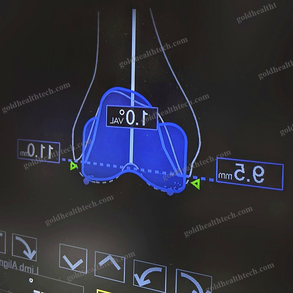 Knee Prosthesis Positioning Surgical Navigation System