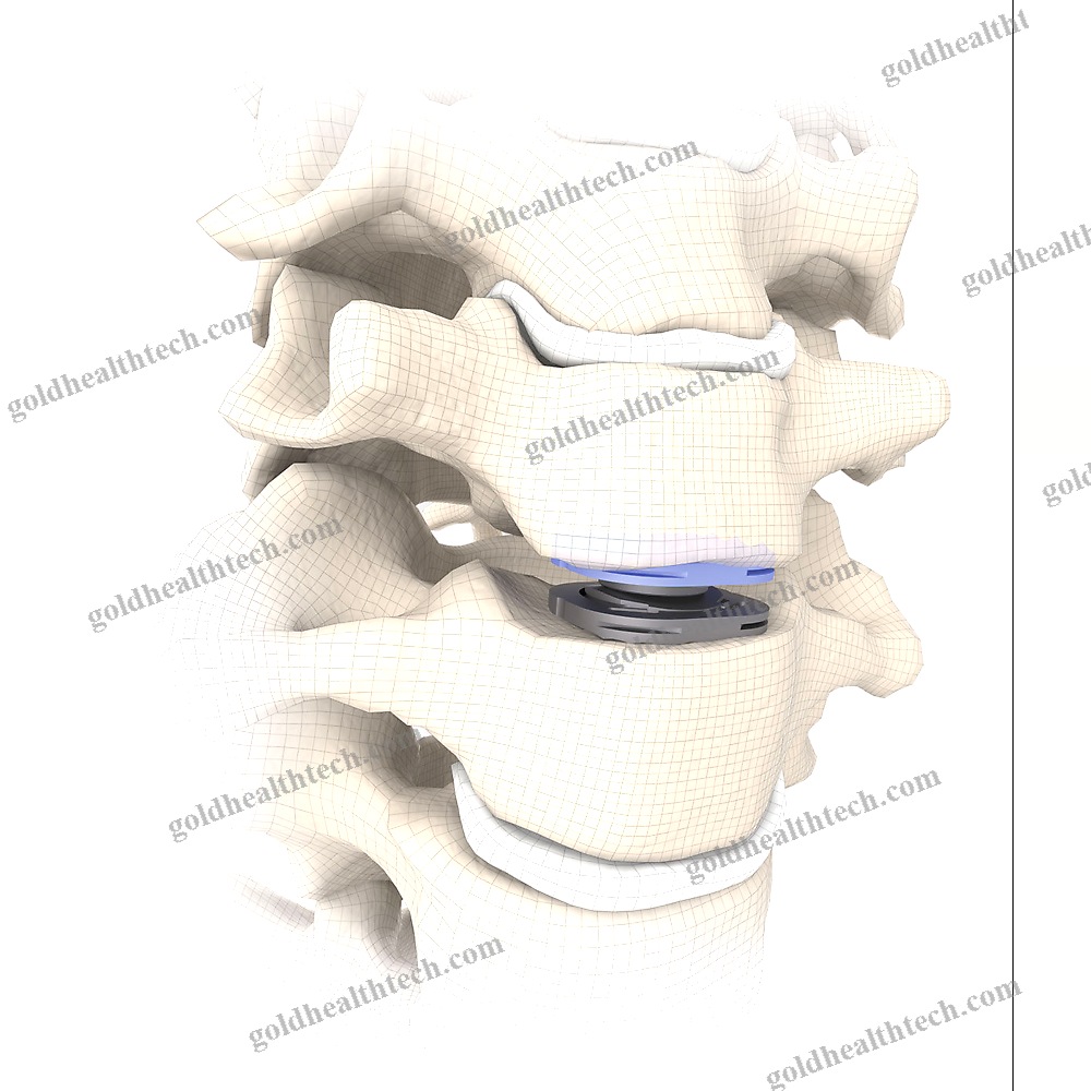 Cervical Disc Prosthesis