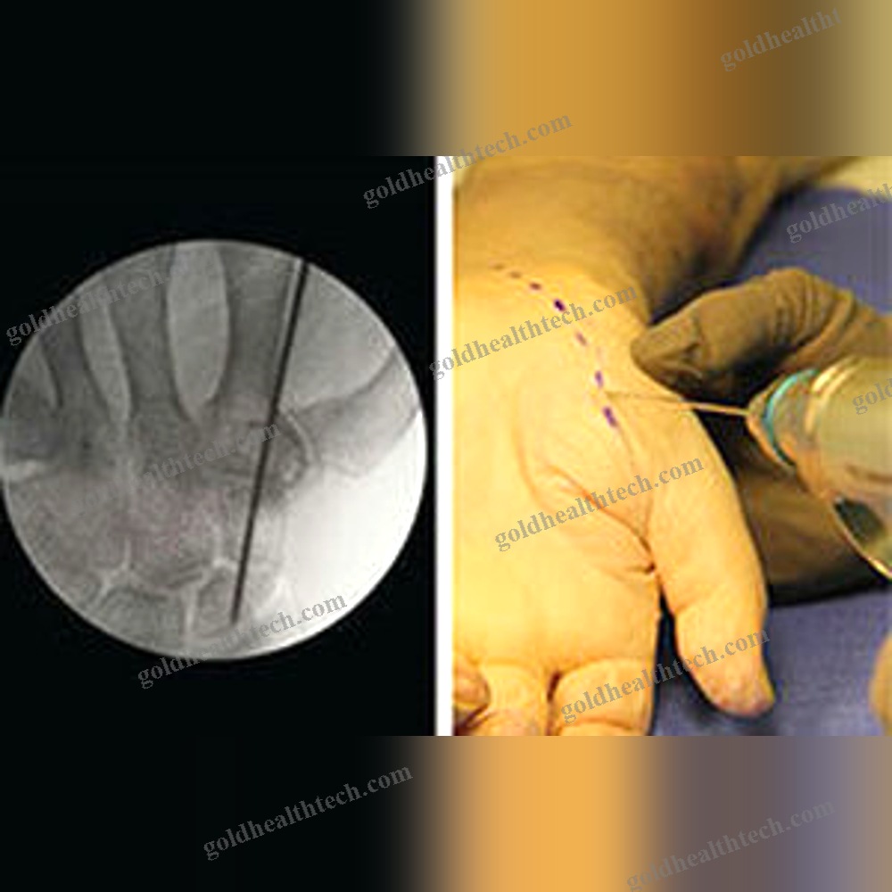 Metacarpophalangeal Joint Arthrodesis Screw