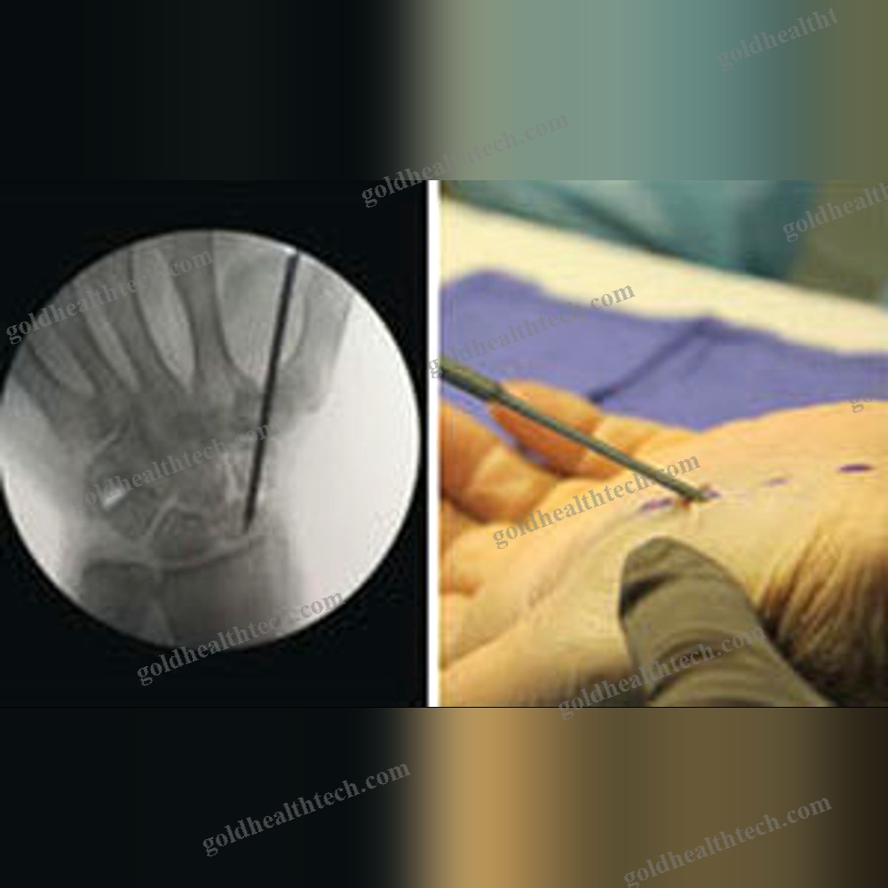 Metacarpophalangeal Joint Arthrodesis Screw