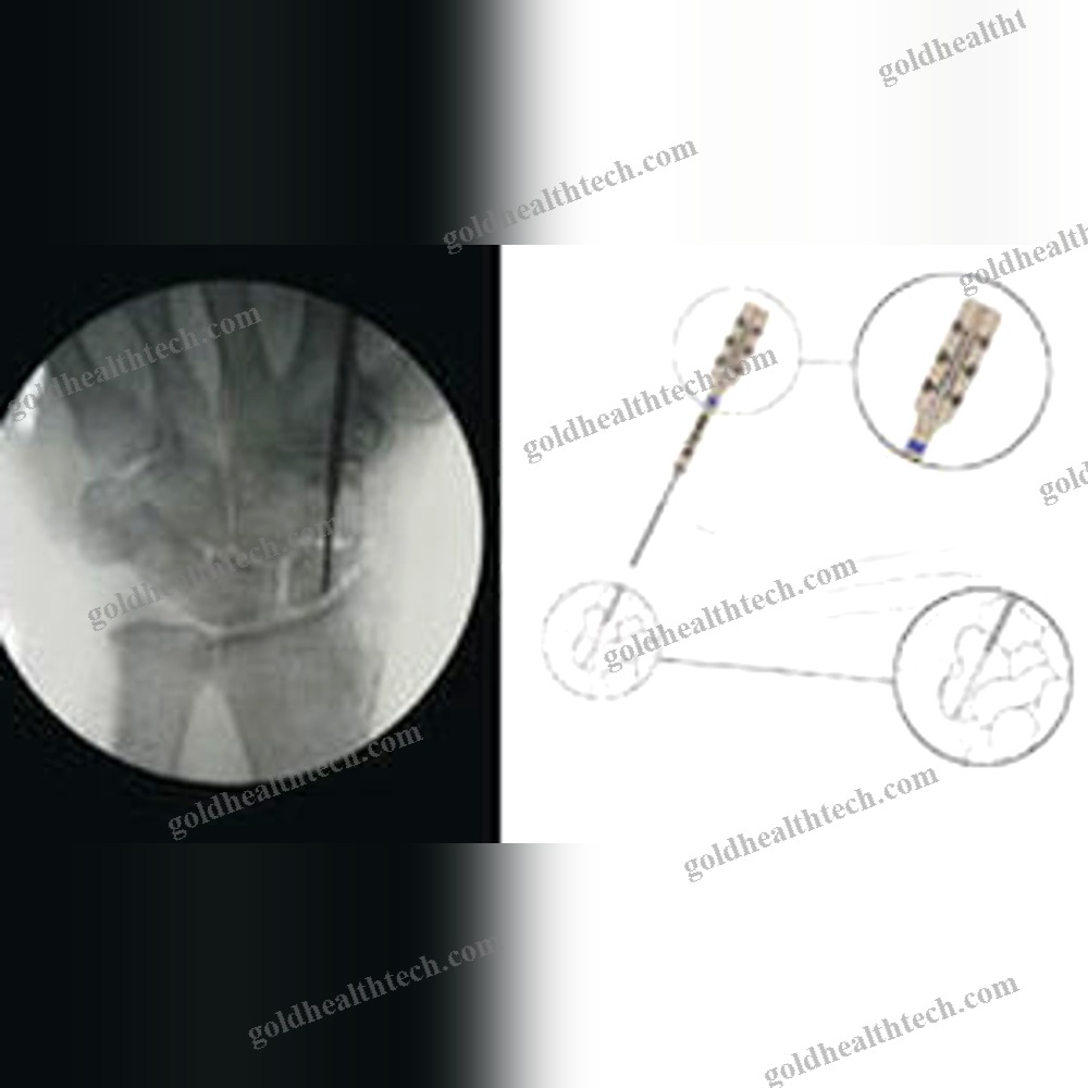 Metacarpophalangeal Joint Arthrodesis Screw