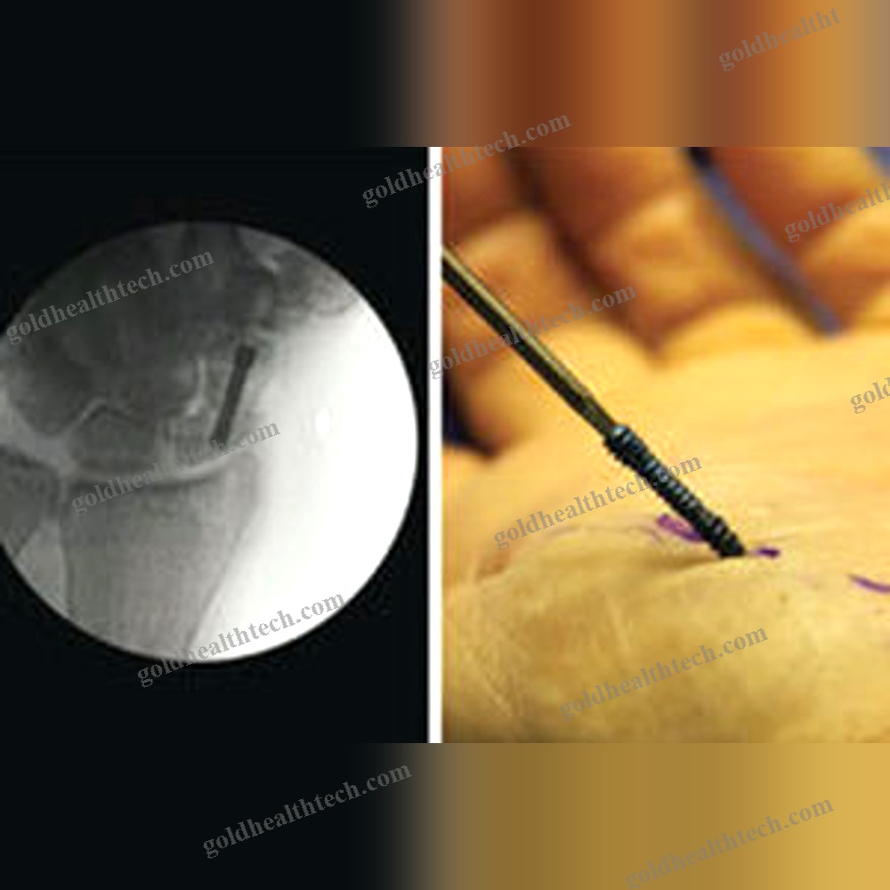 Metacarpophalangeal Joint Arthrodesis Screw