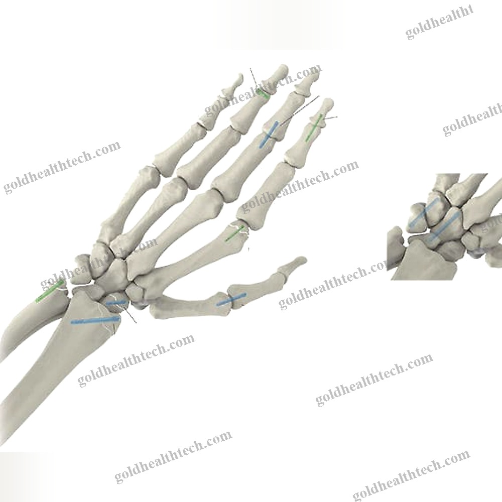 Metacarpophalangeal Joint Arthrodesis Screw