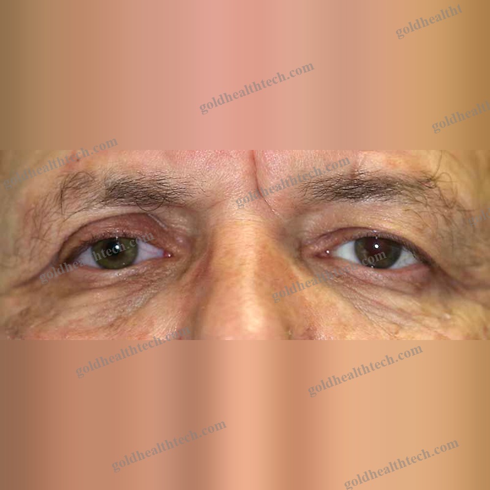 Eye Cosmetic Prosthesis