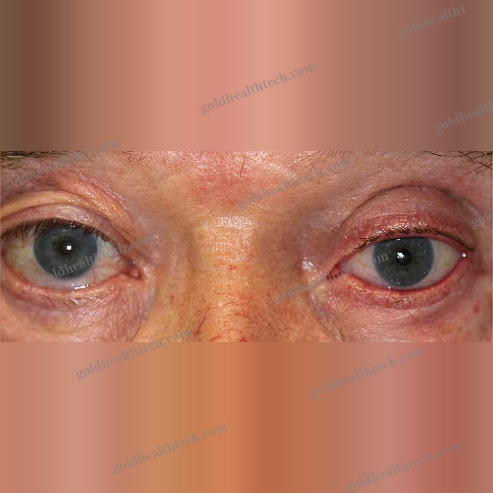 Eye Cosmetic Prosthesis