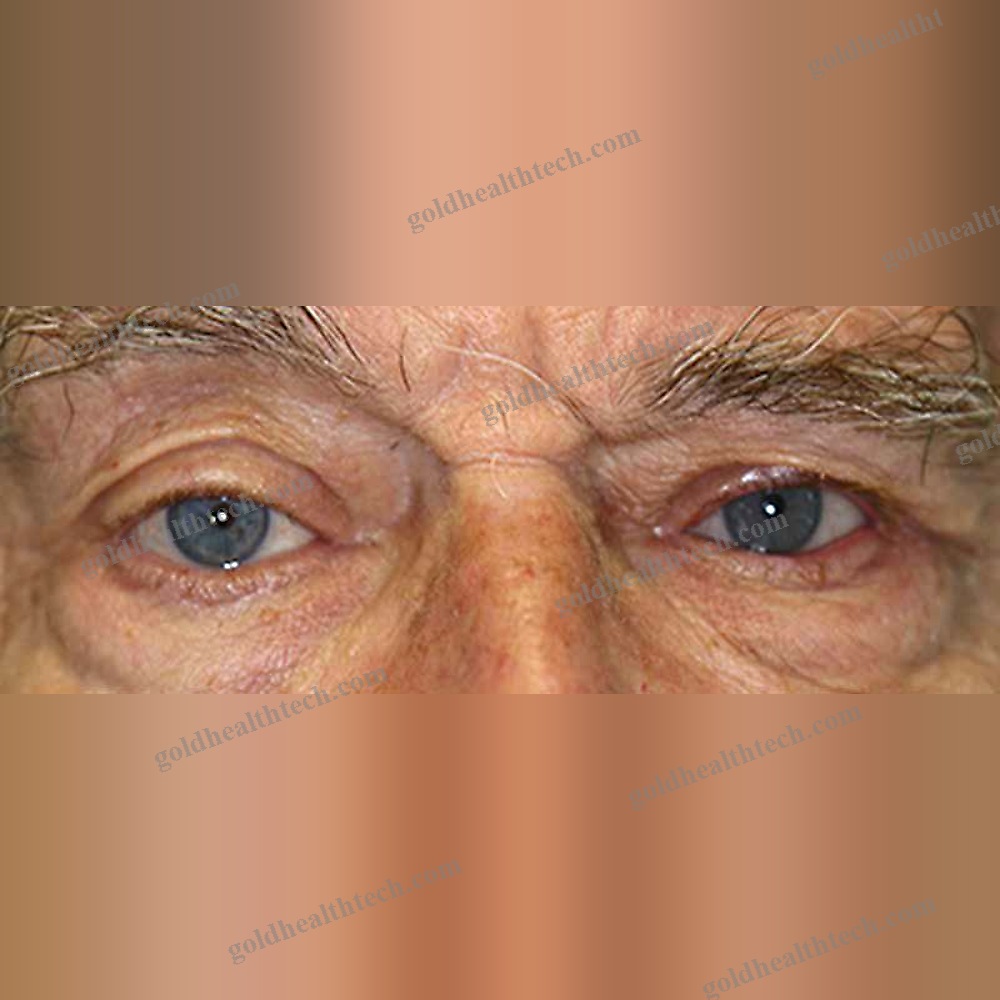 Eye Cosmetic Prosthesis