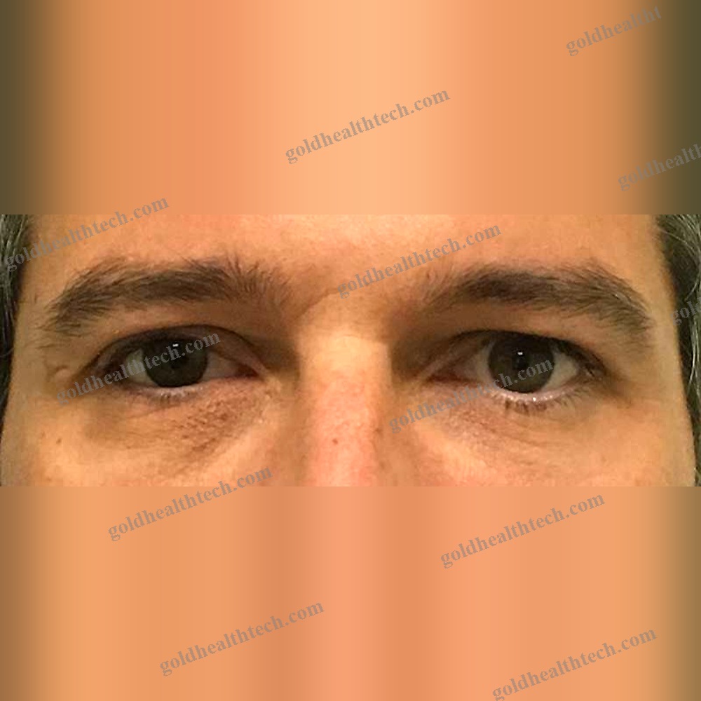 Eye Cosmetic Prosthesis