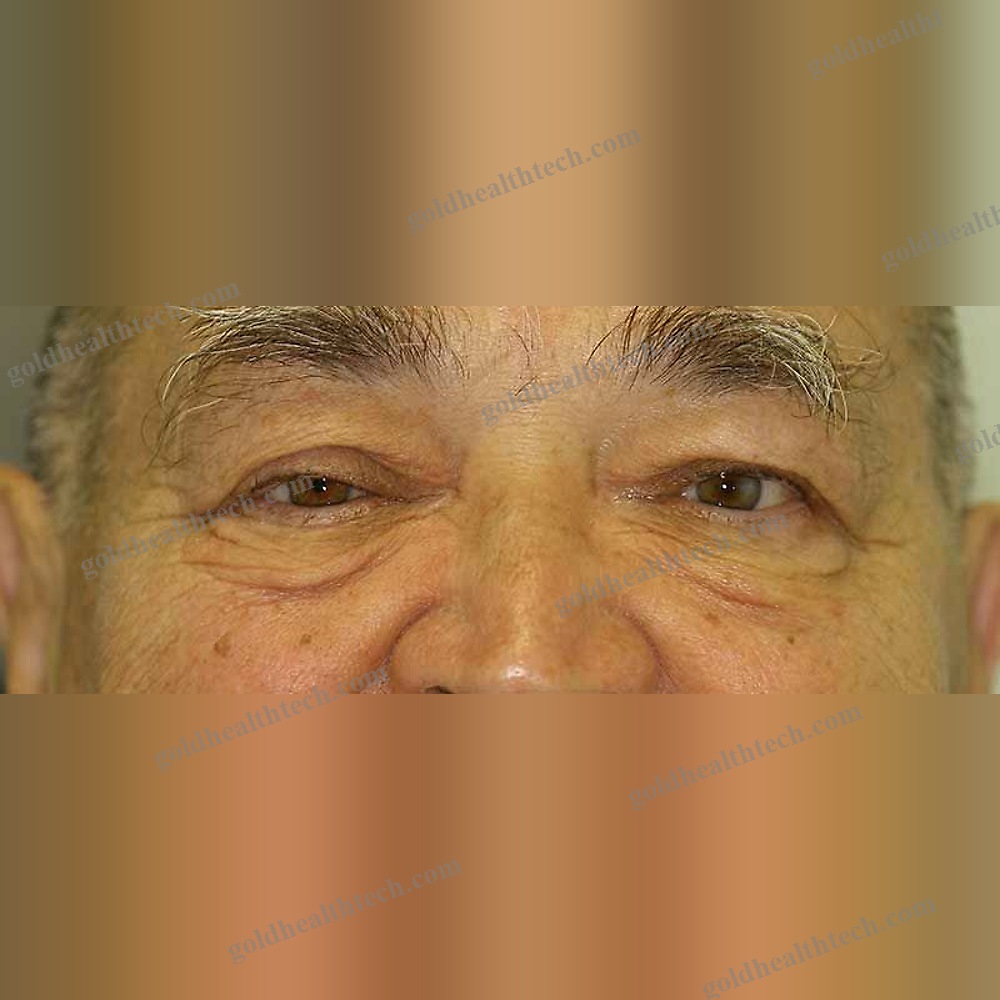 Eye Cosmetic Prosthesis