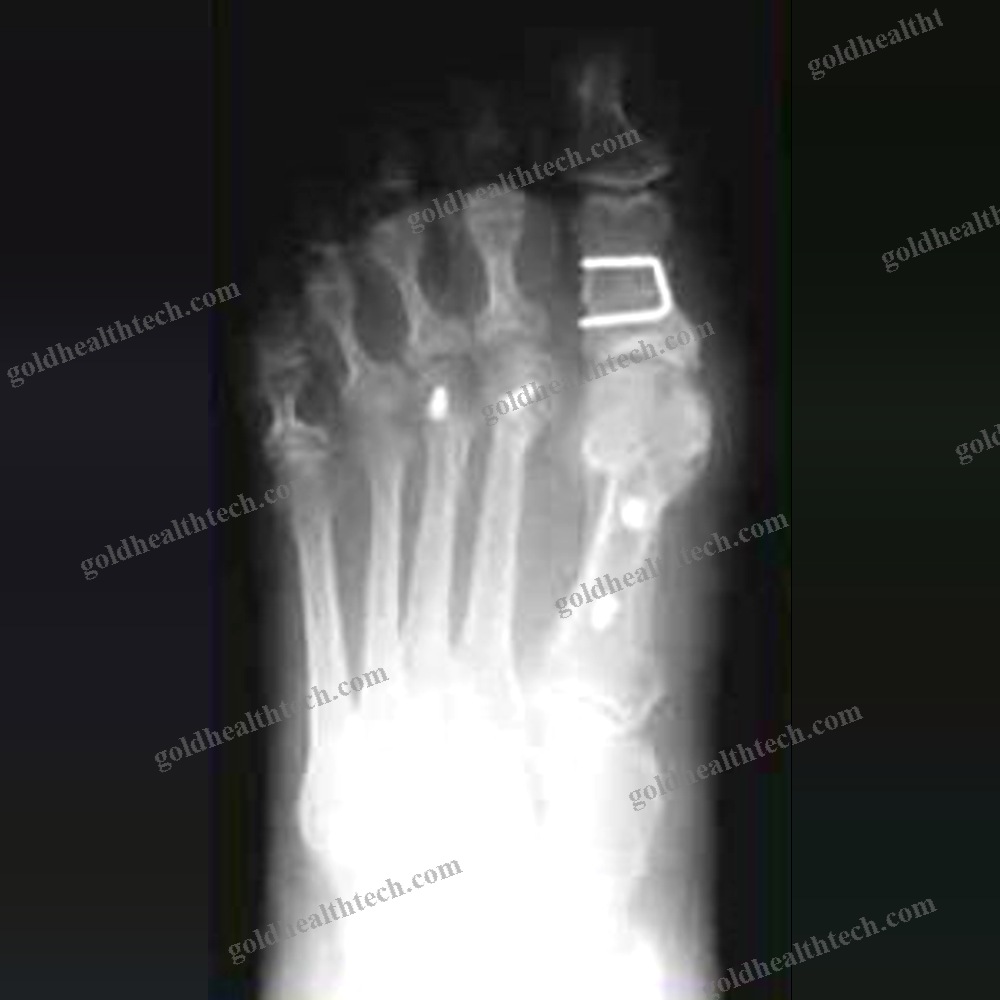 Metatarsophalangeal Joint Osteotomy Screw