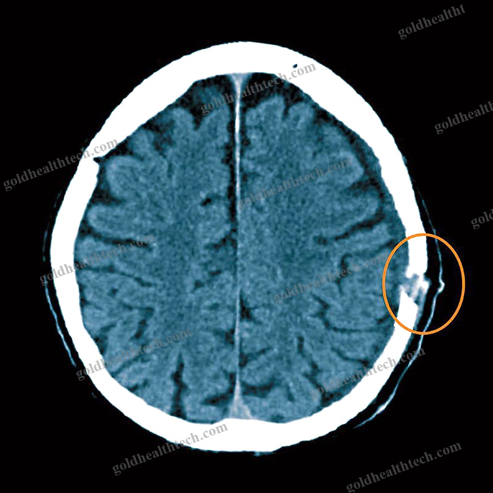 Absorbable Cranial Implant