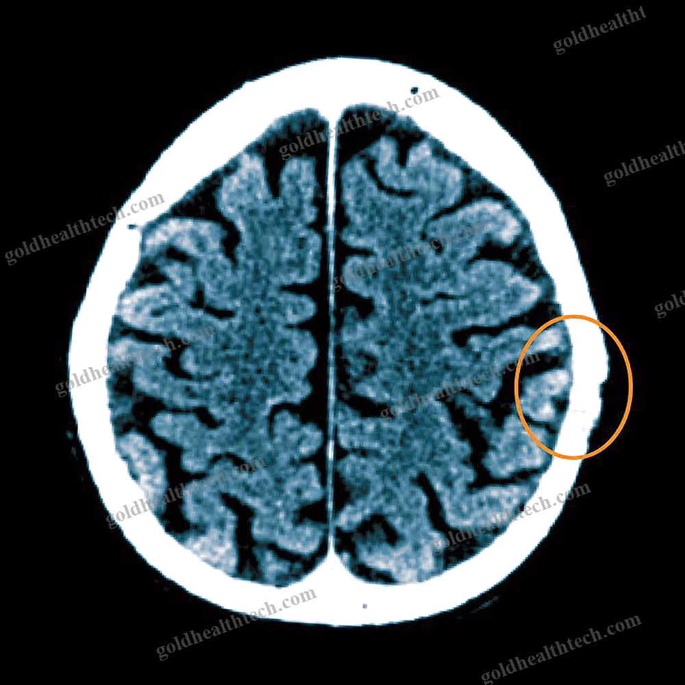 Absorbable Cranial Implant