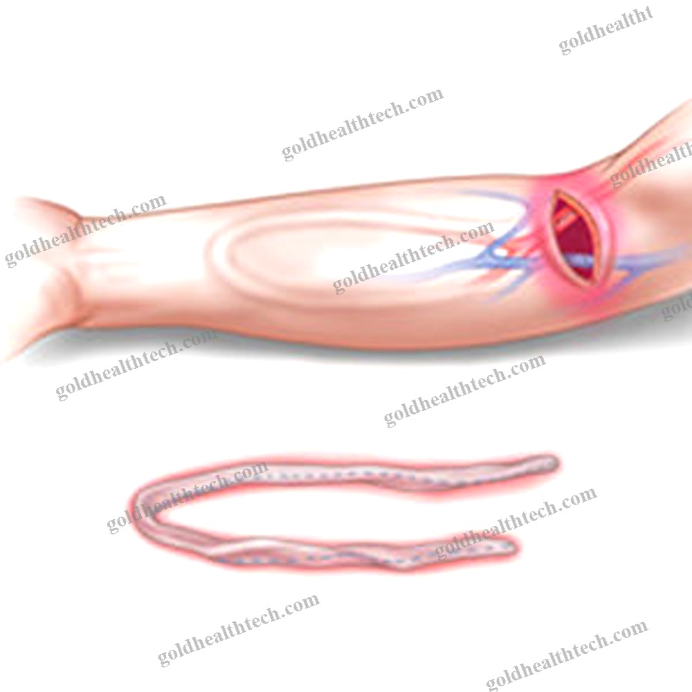 Femoral Vein Vascular Bioprosthesis
