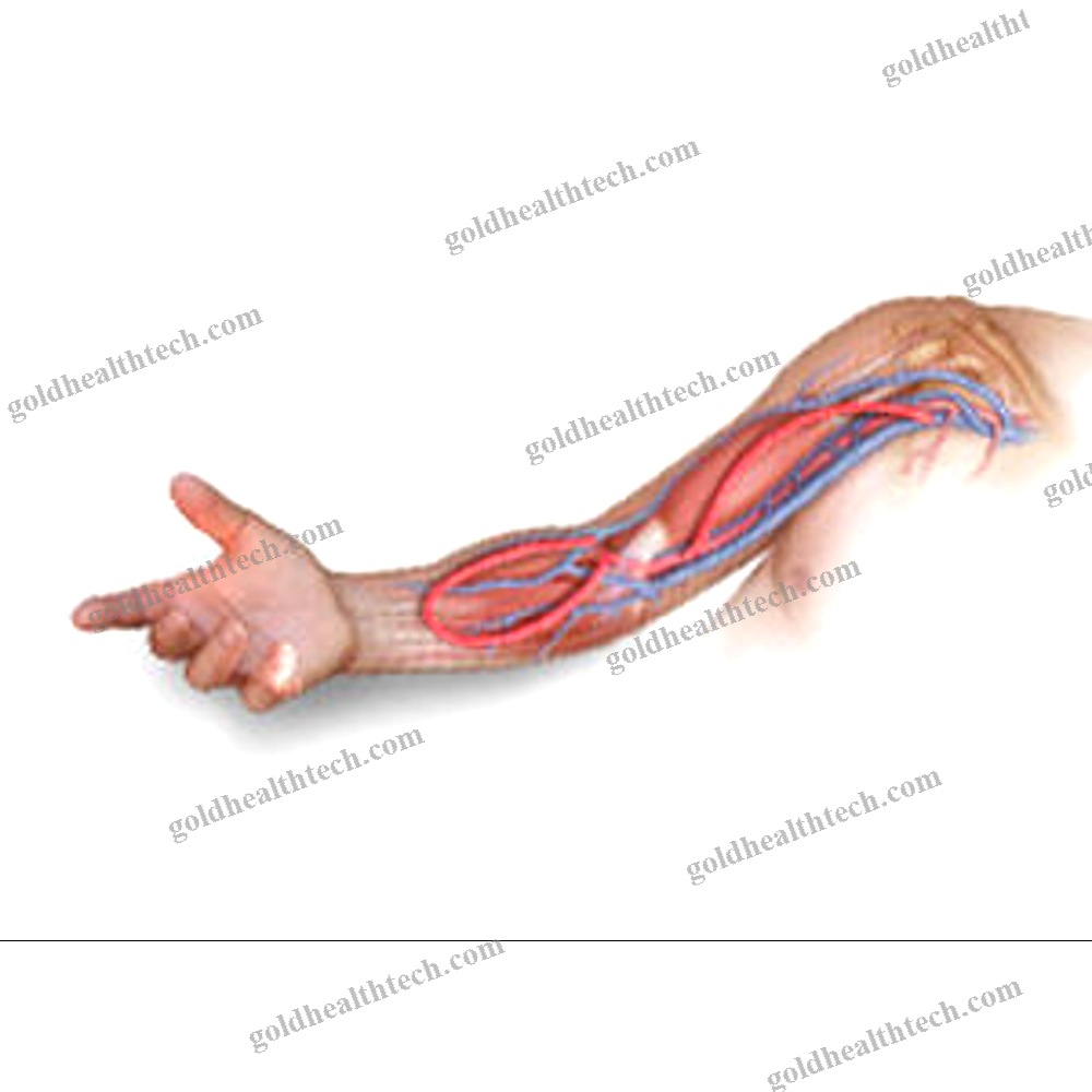 Femoral Vein Vascular Bioprosthesis