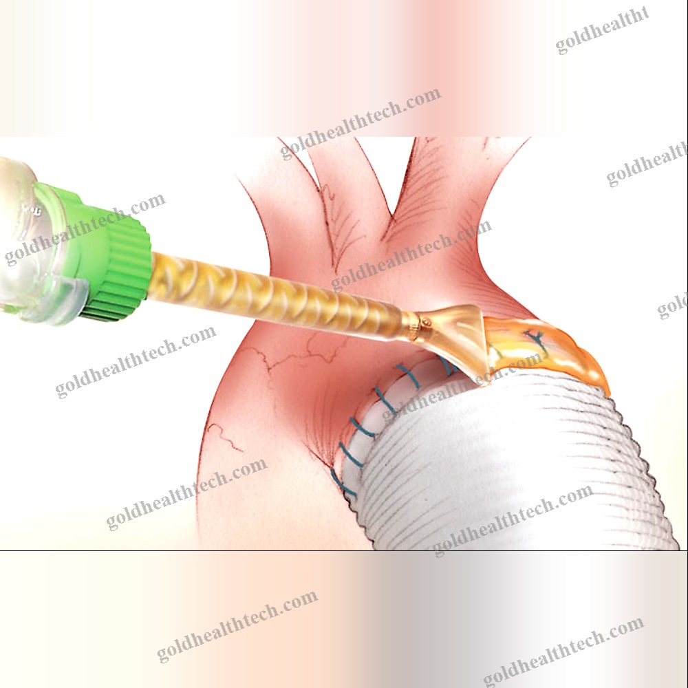 Vascular Surgery Tissue Adhesive