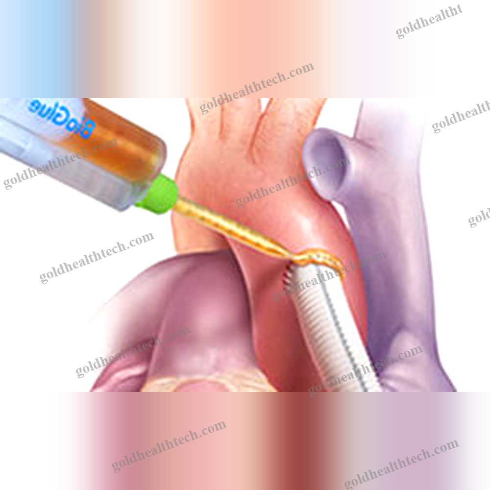 Vascular Surgery Tissue Adhesive