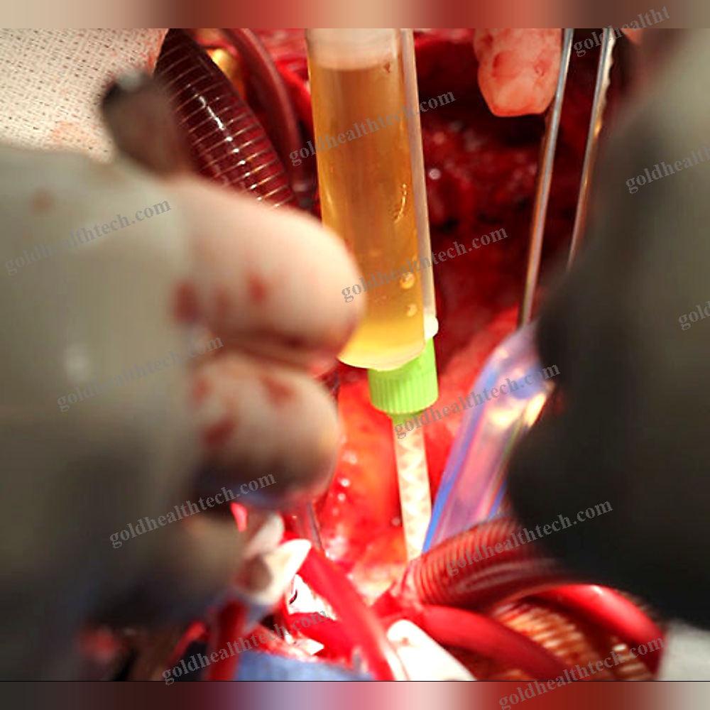 Vascular Surgery Tissue Adhesive