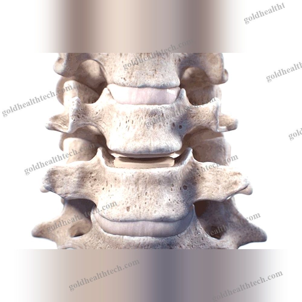 Cervical Disc Prosthesis