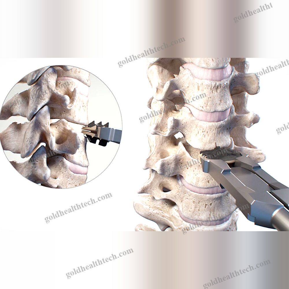 Cervical Disc Prosthesis