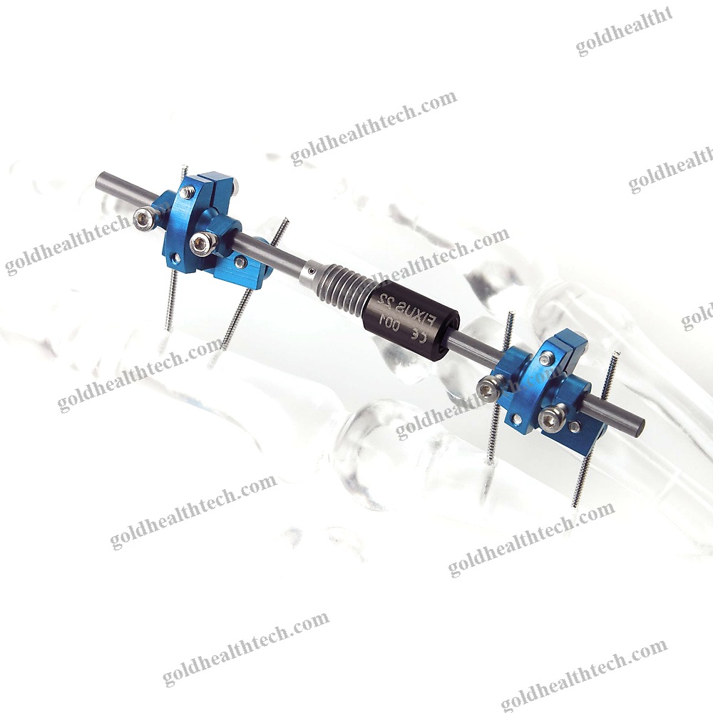 Metacarpophalangeal Joint External Fixation System