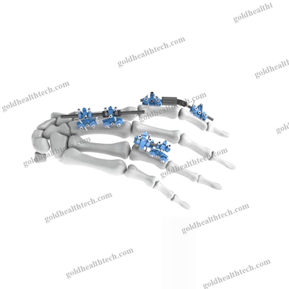 Metacarpophalangeal Joint External Fixation System