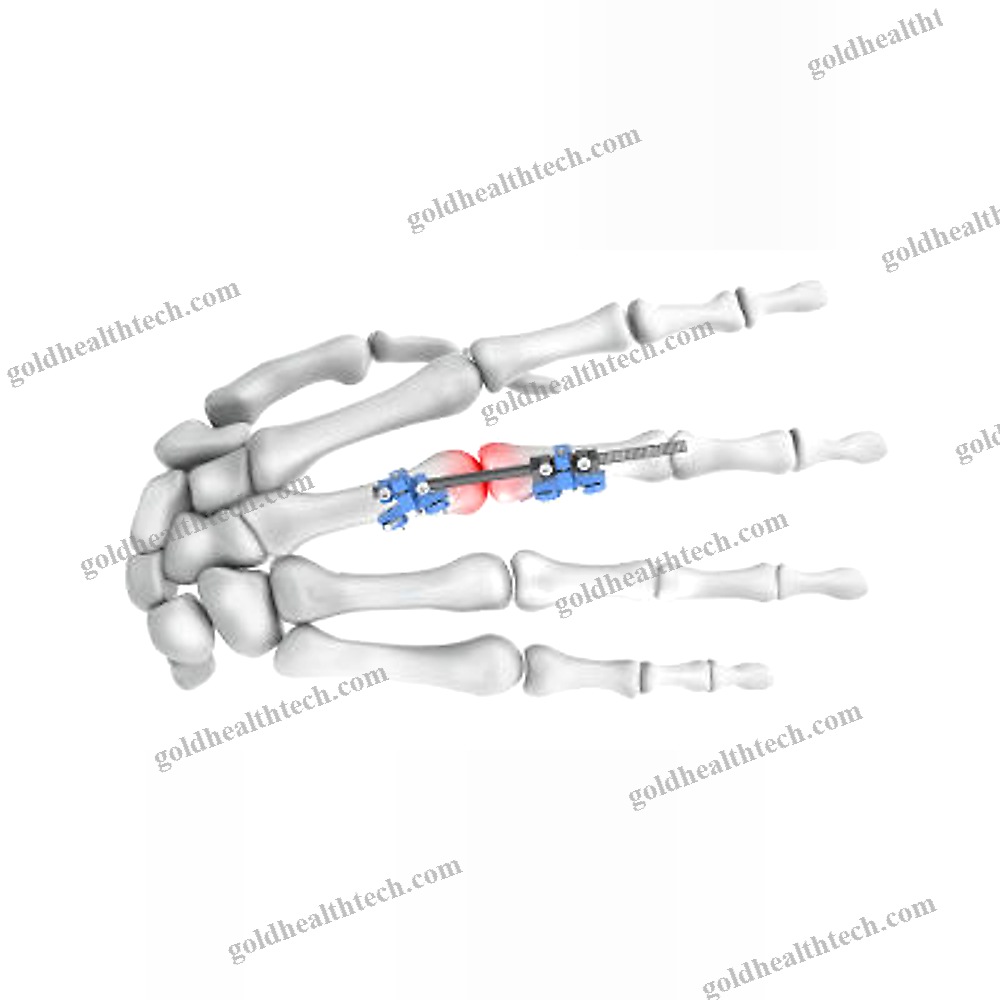 Metacarpophalangeal Joint External Fixation System
