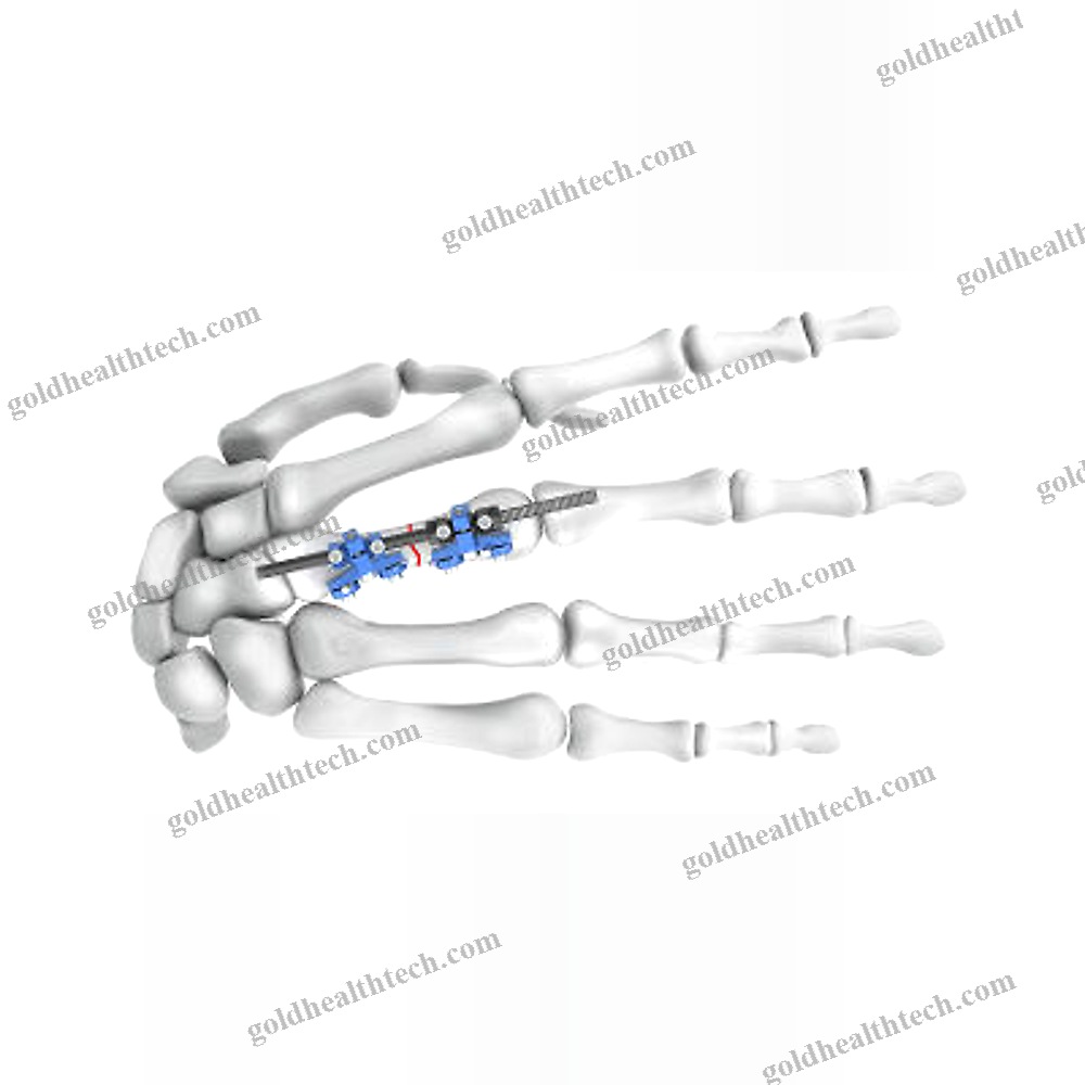 Metacarpophalangeal Joint External Fixation System