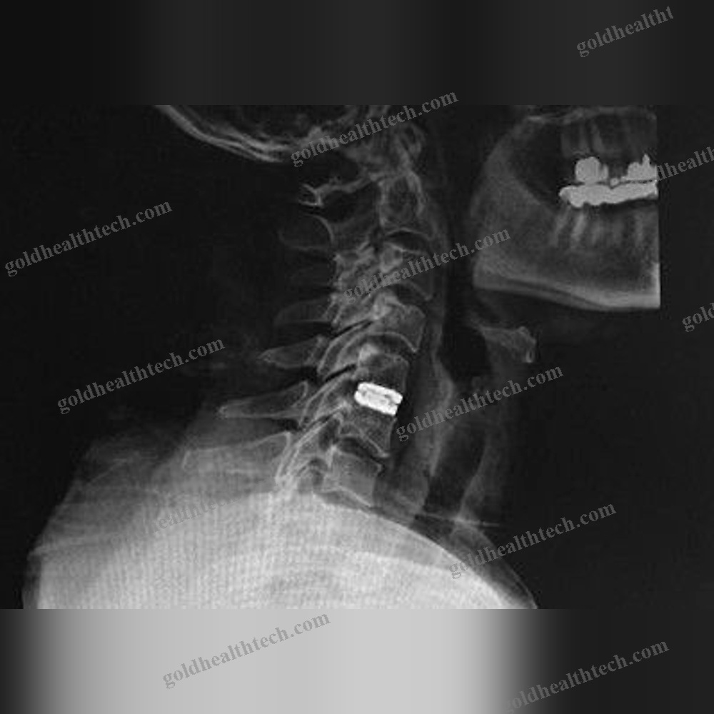 Cervical Disc Prosthesis
