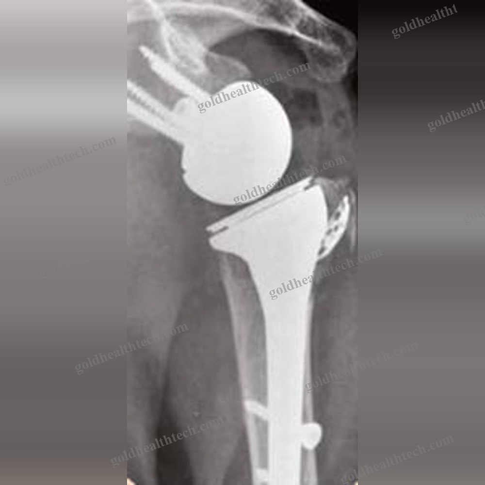 Reverse Shoulder Prosthesis