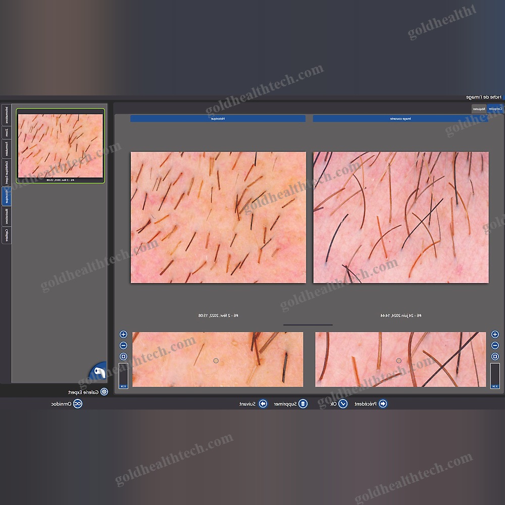 Video Trichoscope