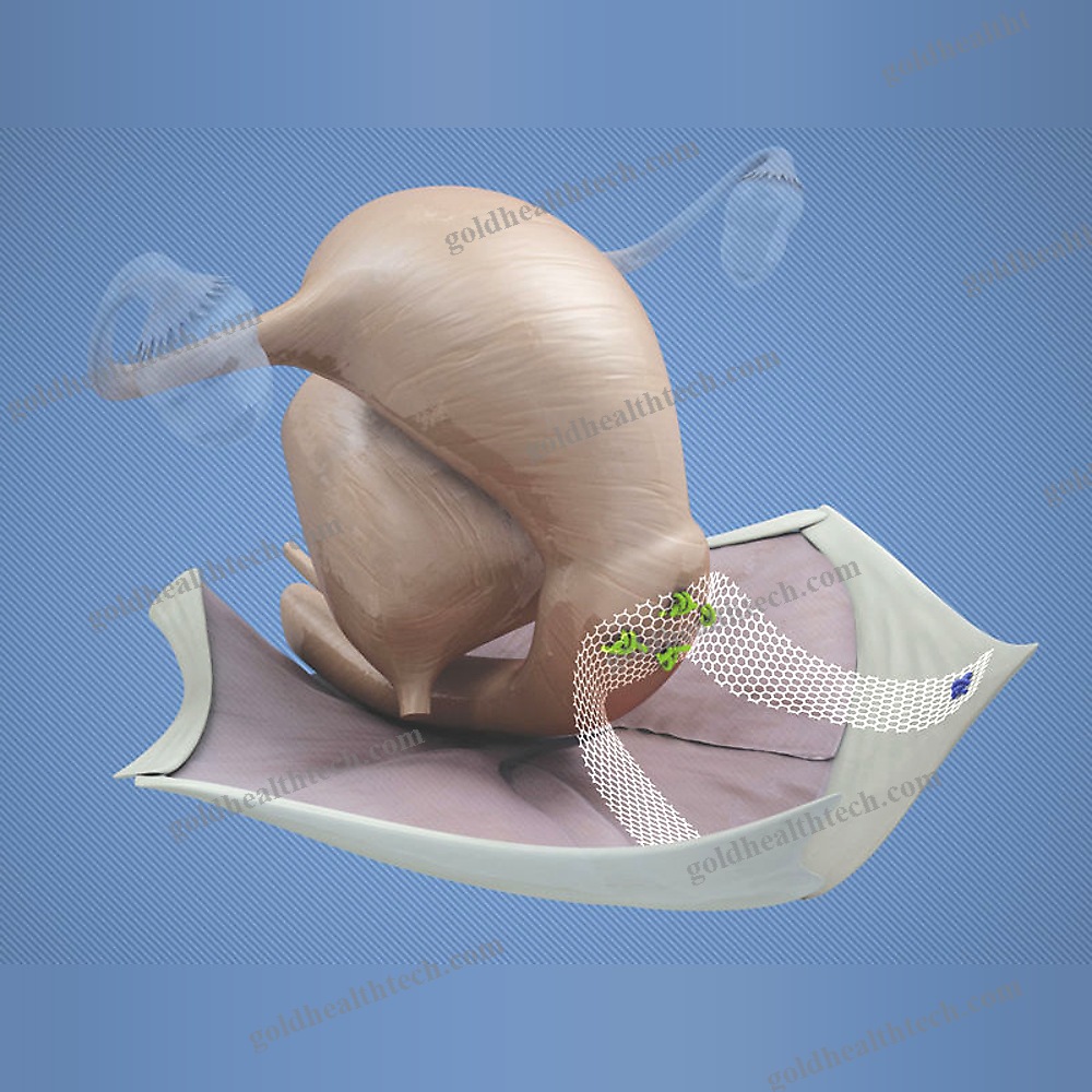 Prolapse Reconstruction Mesh