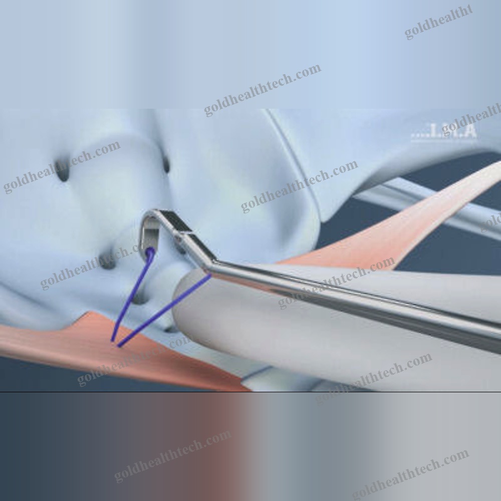Prolapse Reconstruction Mesh