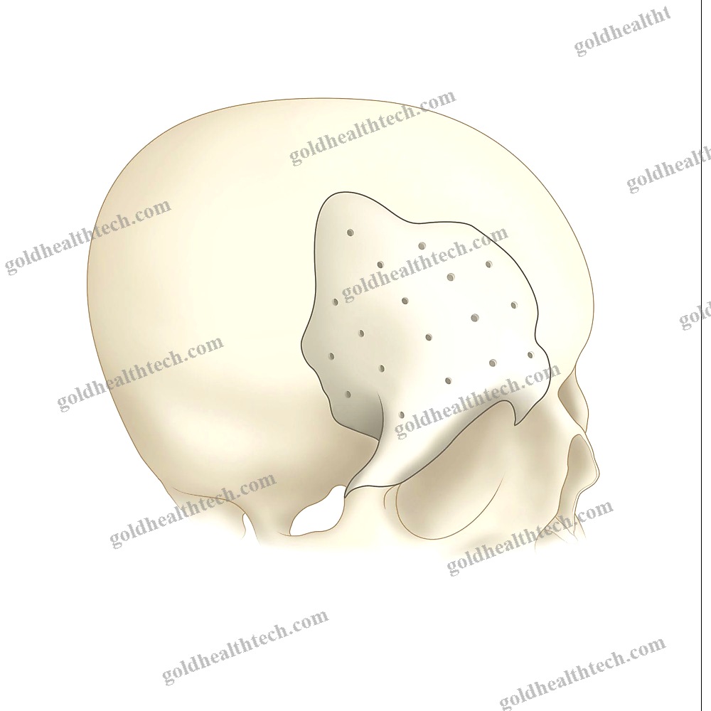 Custom-Made Cranial Implant