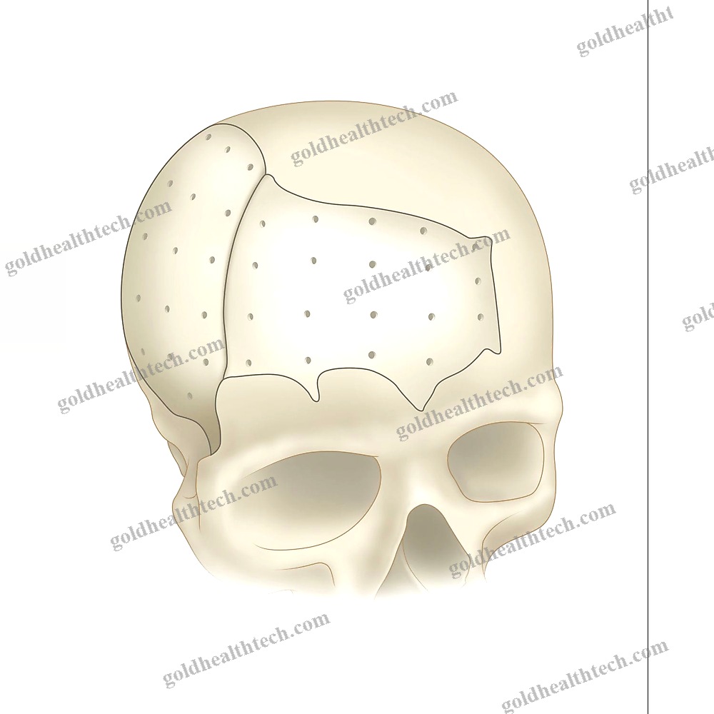 Custom-Made Cranial Implant