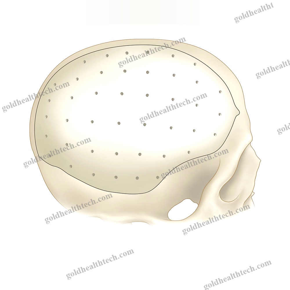 Custom-Made Cranial Implant