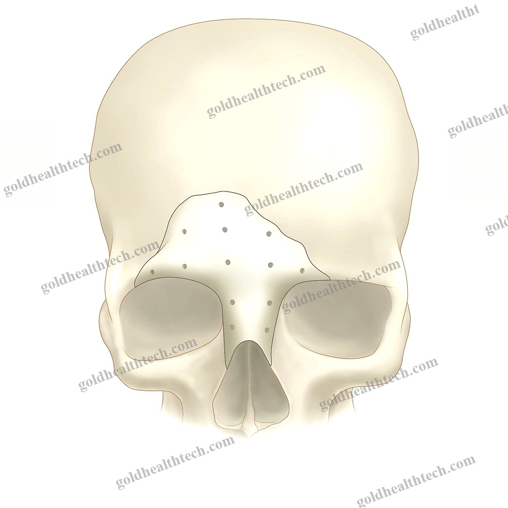 Custom-Made Cranial Implant