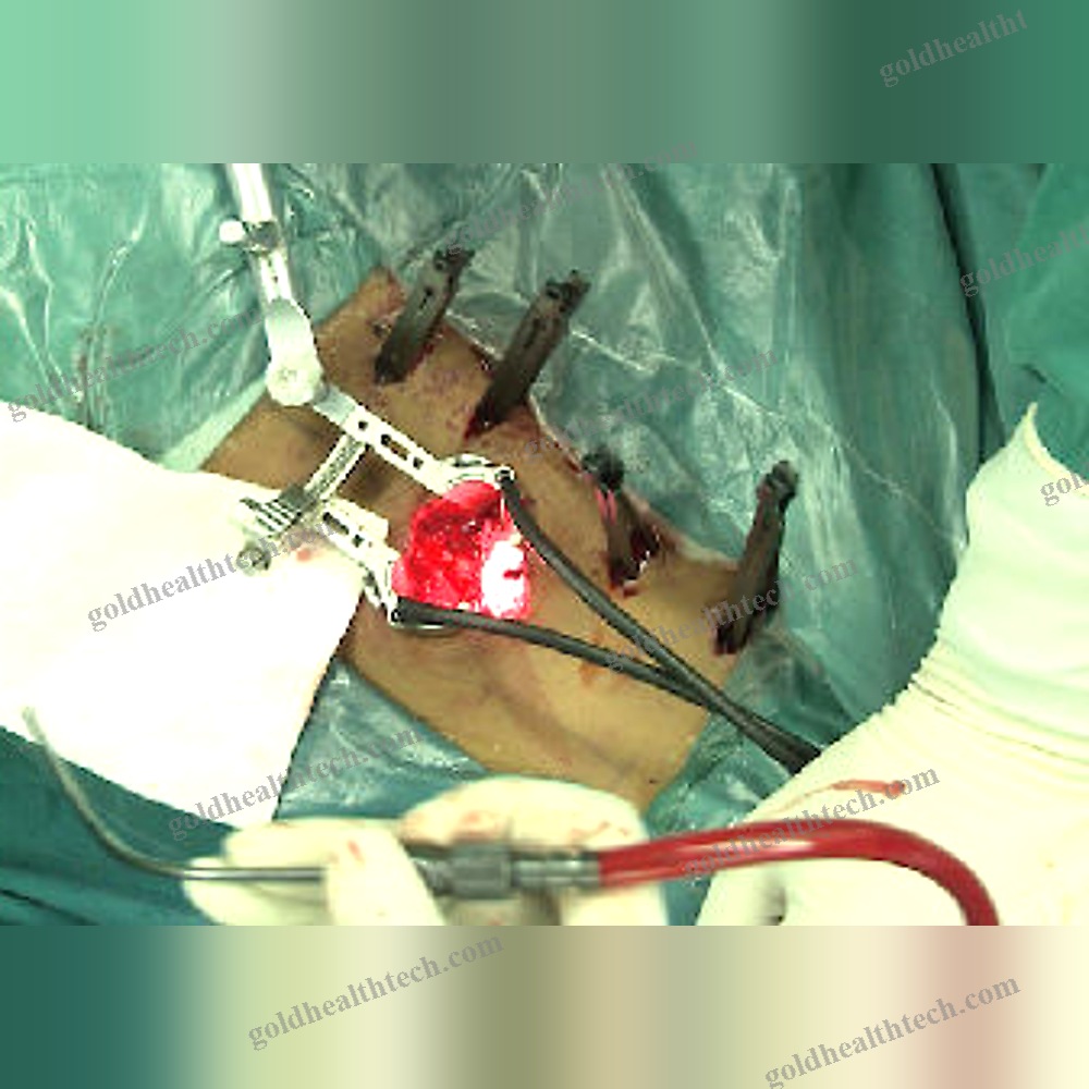 Spinal Retractor