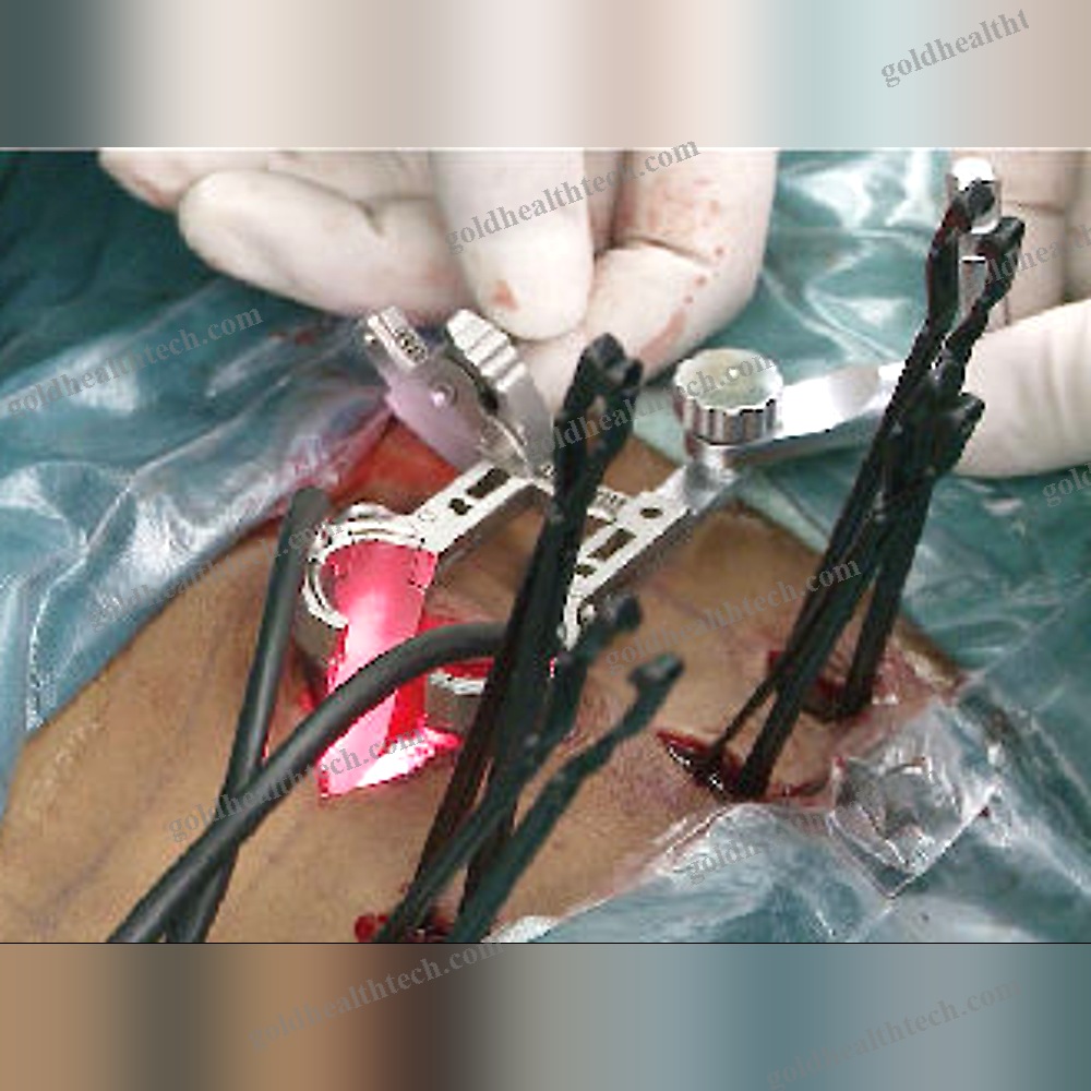 Spinal Retractor