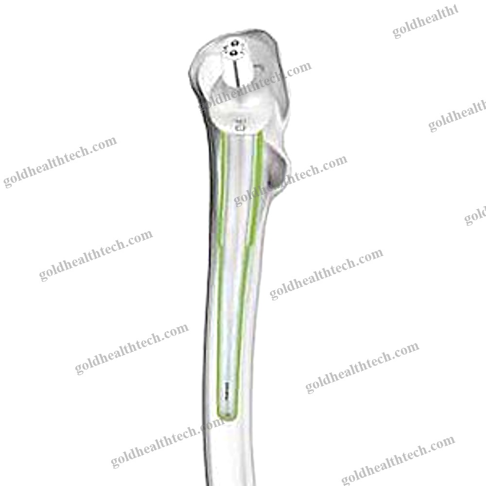Revision Femoral Stem