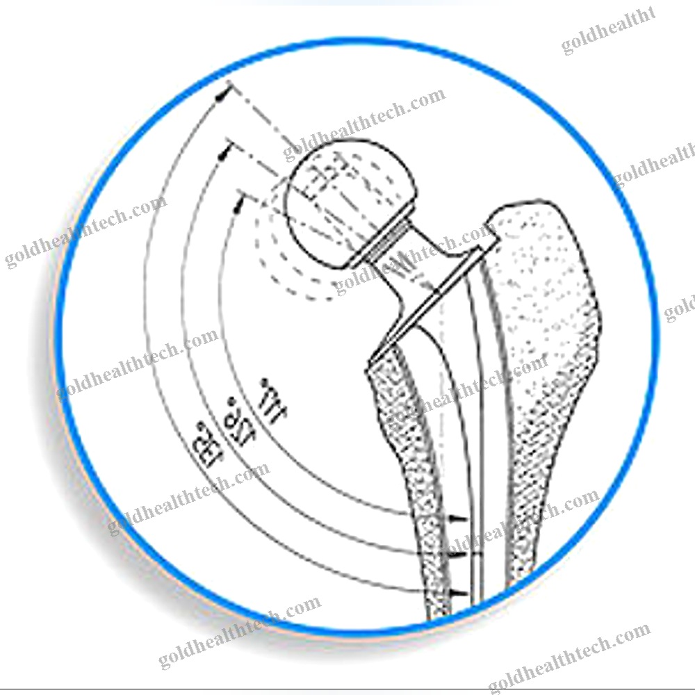 Revision Femoral Stem