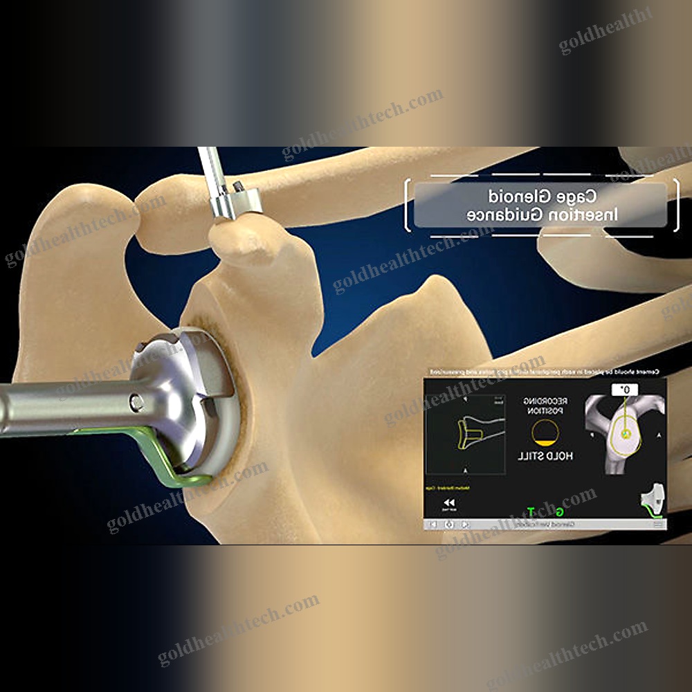 Shoulder Prosthesis Positioning Surgical Navigation System